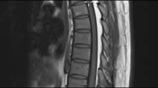 Epidural lipomatosis