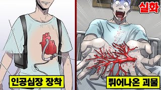 [실화] 인공심장을 달았더니... 입에서 엄청난 게 튀어나온 남자