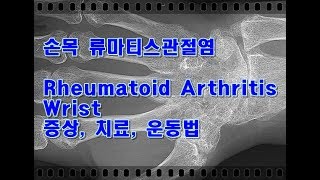 류마티스 관절염(Rheumatoid Arthritis) : 손목