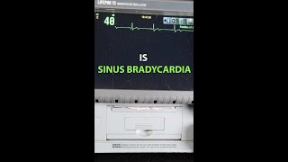 What is Sinus Bradycardia?