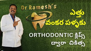 ఎత్తు వంకర పళ్ళకు Orthodontic క్లిప్స్ ద్వారా  చికిత్స Clip Treatment for Teeth | Dr.S.V.RAMESH GOUD