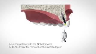 Abutment Retrieval Zirconia