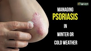 சொரியாசிஸ் பிரச்சனைக்கு தீர்வு ... Psoriasis Treatment | Doctor On Call | PuthuyugamTV