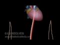 myocardial infarction and coronary angioplasty treatment animation.