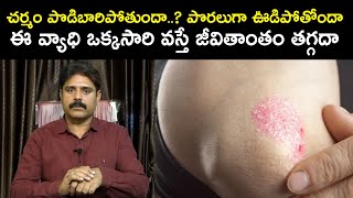 చర్మం పొడిబారిపోతుందా? పొరలుగా ఊడిపోతోందా ఈ వ్యాధి ఒక్కసారి వస్తే జీవితాంతం తగ్గదా|Dr. Sridhar Reddy