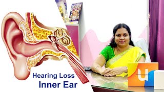 Reasons of Hearing Loss -Part III - Inner Ear | கேட்கும் இழப்புக்கான காரணங்கள் -பகுதி III - உள் காது