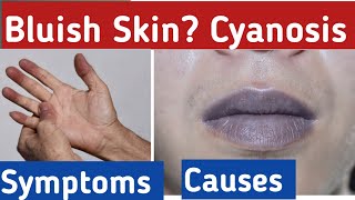 What is Cyanosis- bluish skin, cyanosis symptoms, what is the cause of cyanosis?