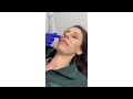 Lip Augmentation | Restylane Refyne | RS Plastic Surgery