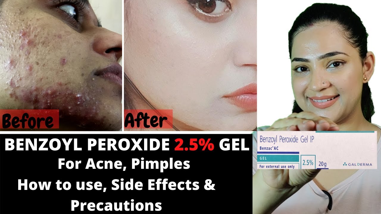 Benzoyl Peroxide Uses & Side Effects | Gel For Ance / Pimples / Clogged ...