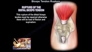Distal Biceps Tendon Rupture - Everything You Need To Know - Dr. Nabil Ebraheim