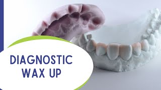 Diagnostic Wax up
