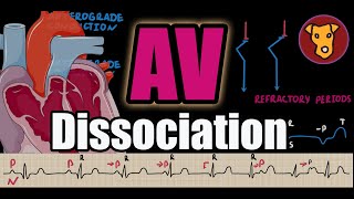 ATRIO-VENTRICULAR (AV) DISSOCIATION. Classification, pathophysiology, ECG CRITERIA, examples.