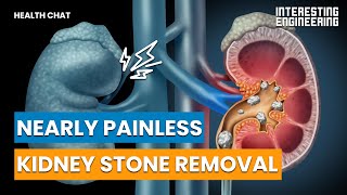 Remove Kidney Stones Without Anesthetics