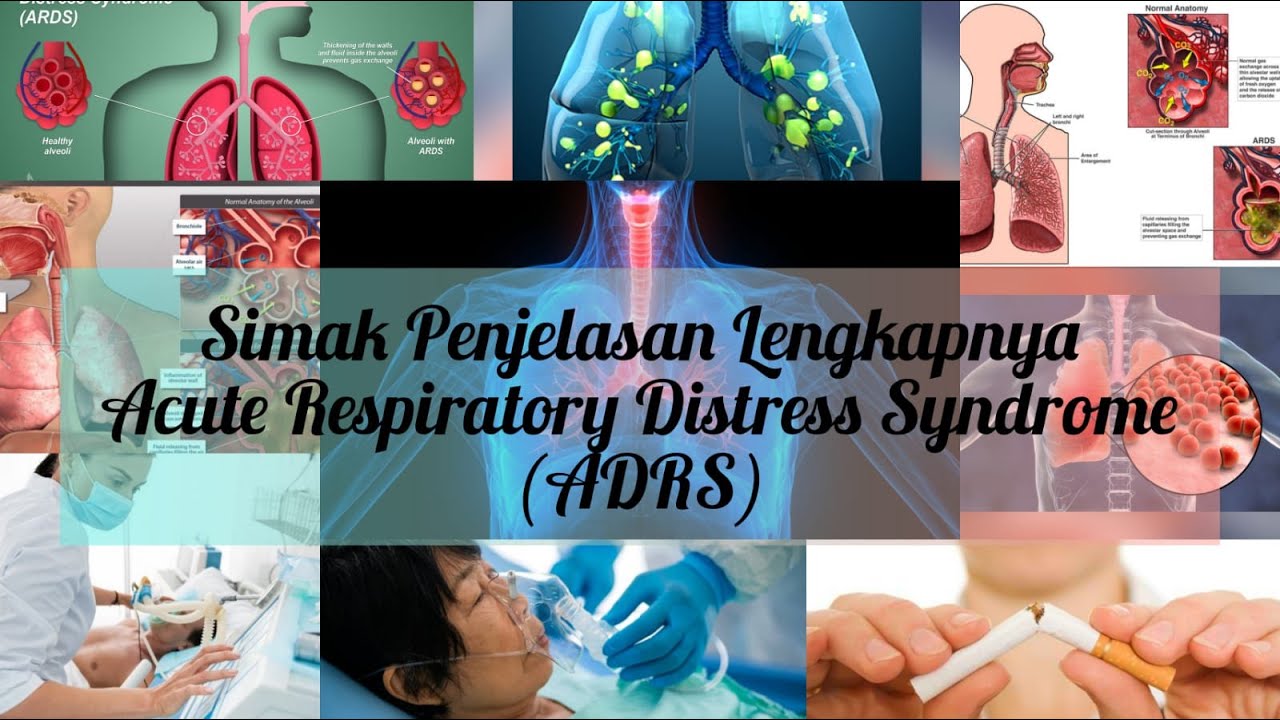 Acute Respiratory Distress Syndrome (ARDS): Penyebab,Gejala, Diagnosis ...