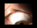 Contact Lenses - SCL Assessment of fit & Removal