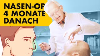 Nachkontrolle 4 Monate nach Geschlossener Nasenkorrektur | mit OP-Aufnahmen! | Dr. Jungwirth