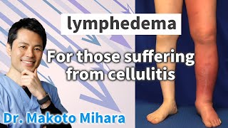 Quick Guide: Preventing Cellulitis in Lymphedema Patients | Dr. Makoto Mihara in 3 Minutes