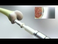 biopoly rs knee system animation