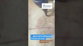 รักษาปานน้ำตาลด้วยเลเซอร์ Picosecond Laser หมอรุจชวนคุย ปานดำ ปานแต่กำเนิด