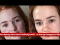 pimples మొటిమలు మచ్చలు గుంతలు పోగొట్టే పేస్ట్ ఇది dr manthena satyanarayana raju good health