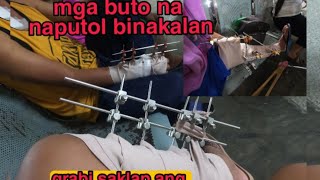 Mga BaLing Buto namin Kinabitan ng BAKAL | Grabi ang Mahal ng Bakal ng mga Nakasabay ko sa Check Up