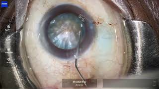 Management of Mature Intumescent Cataract : Dr Sheetal Brar