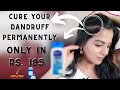 DANDRUFF | HOW TO GET RID OF DANDRUFF PERMANENTLY IN Rs. 185