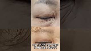 50대 여성의 과한 눈주름제거 수술 눈주름제거수술 #눈주름 #눈주름제거수술