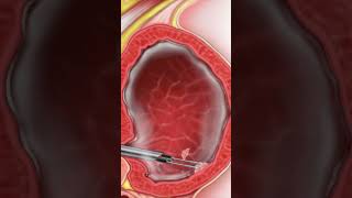 TURBT: Transurethral Resection of Bladder Tumor - Why is it done?  #BladderCancer #Surgery #shorts