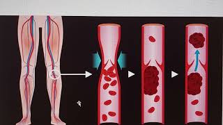 DVT: A deadly travelers companion