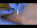 cherry angioma removal with lamprobe