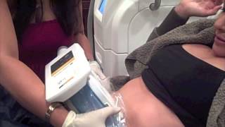 Coolsculpting with Dr  Yue