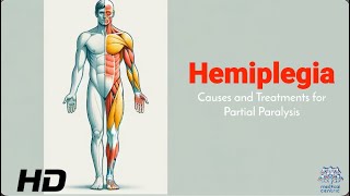 Hemiplegia 101: Identifying Causes and Exploring Effective Therapies