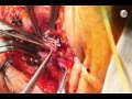 debranching for zone 1 hybrid tevar retropharangeal carotid to carotid bypass