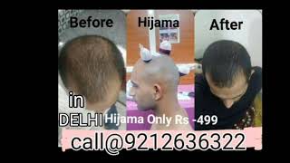 Hijama Treatment Stop Hair Fall By Hijama Treatment Grow New