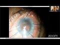 aioc2021 ic594 topic dr malik k p s hypermature cataract rhexis escaped