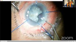 AIOC2021 - IC594 - Topic - Dr Malik K P S  -  Hypermature Cataract Rhexis escaped