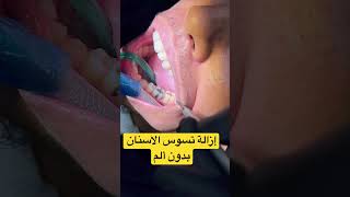 إزالة تسوس الاسنان بدون ألم #teeth #dental #care #whitening #طبيب_اسنان #جعفر_العمدة #comedy