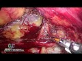 laparoscopic right partial nephrectomy surgical videos