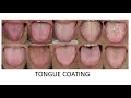 TONGUE DIAGNOSIS: Coating