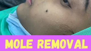 Mole removal within one minute | তিল দূর করুন মাত্র ১ মিনিটে