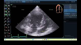 IQ 361 AFI RV HEART WORM DISEASE ECHOPAC ANALYSIS ECHOCARDIOGRAPHY，心絲蟲,small animal