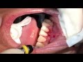 AlloDerm® Gum Grafting Performed by Dr. John Paul Gallardo | Miami, FL