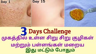 முகத்தில் உள்ள பள்ளங்கள் மறைய / How to get rid of large open pores permanently / Close open pores