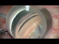 combined cataract procedure with istent glaucoma implant