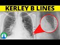 Kerley B Lines (Medical Definition) | Quick Explainer Video