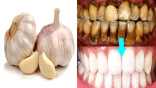 பற்களை பாதுகாக்க பூண்டு பயன்பாடு | How to whiten teeth naturally at home with Garlic