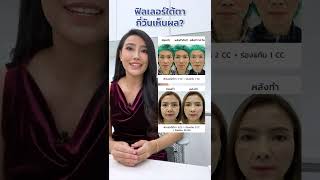 ฉีดฟิลเลอร์ใต้ตากี่วันเห็นผล? หลังฉีดฟิลเลอร์ใต้ตา รีวิวฟิลเลอร์ใต้ตา | V Square Clinic