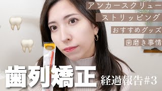 【歯列矯正#3】アンカースクリュー矯正スタート🦷痛みは…？矯正中の歯磨き事情\u0026使っている歯ブラシ【7ヶ月目の口元の変化】