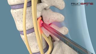 Full-endoscopic spinal treatment of herniated discs and spinal canal stenosis